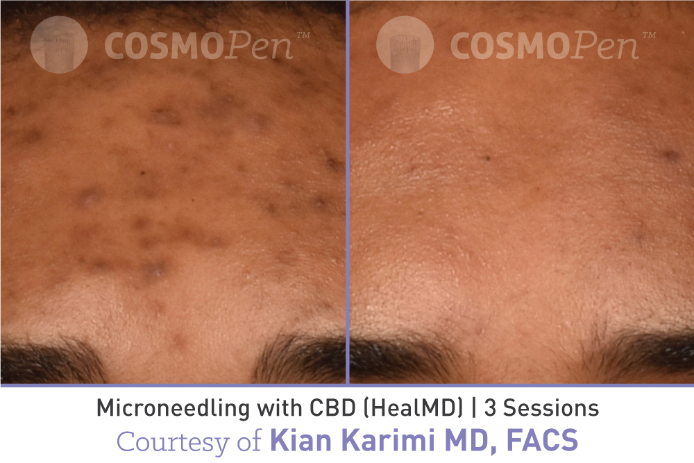 treatment with cosmopen and healmd
